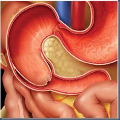 Neonataal abdomen Subtotale duodenum