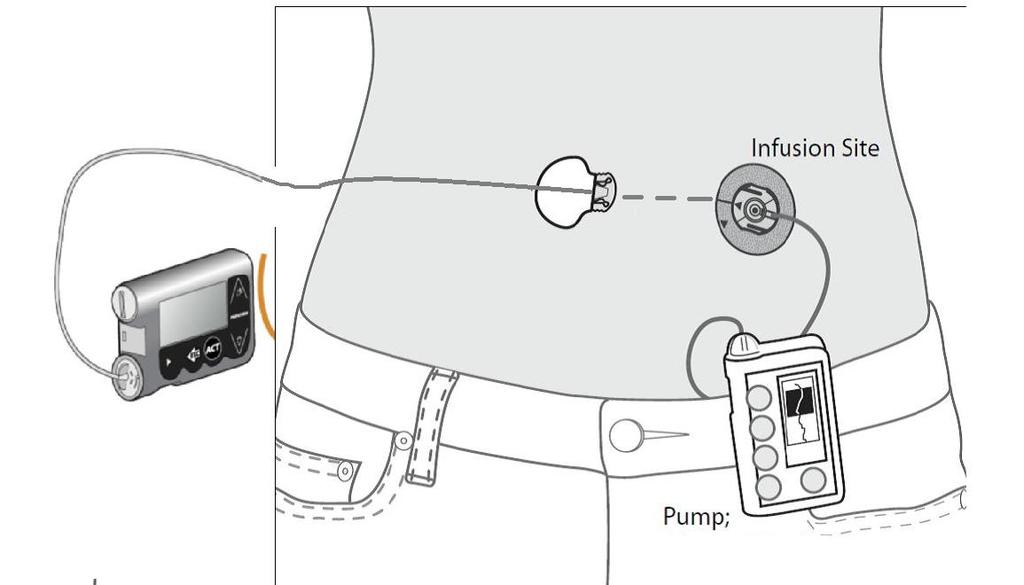 Microdialyse Dialysis