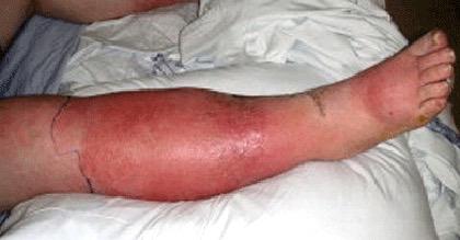 cellulitis: 10-28 dagen, wondinfecties) musculoskeletale infecties (vb. osteomyelitis: min.