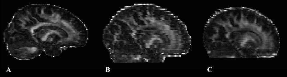 gescand met twee verschillende merken MRI-scanners, waarbij de ene fabrikant een andere definitie bleek te hanteren van een bepaalde instelling dan de andere fabrikant).