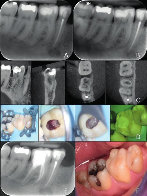 Klinische casus II: Gecombineerde chirurgische en niet-chirurgische toegang Figuur 2 Röntgenstralen voor de behandeling (A en B), waarvan de verwijzende tandarts zo vriendelijk was om deze te delen
