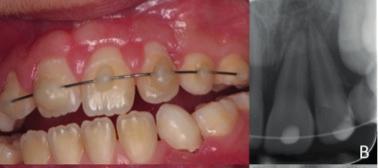 met beperkte complicaties. Verwijzingen: Cohenca N, Silberman A. Contemporary imaging for the diagnosis and treatment of traumatic dental injuries: A review. Dent Traumatol. 2017; 33:321-328.