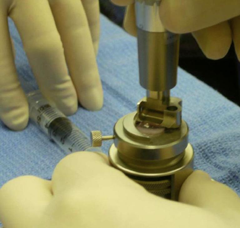 Figuur 4 laat het preparen en inbrengen van een donorla- a b c d e FIGUUR 4 Descemet stripping automated endothelial keratoplasty (DSAEK).