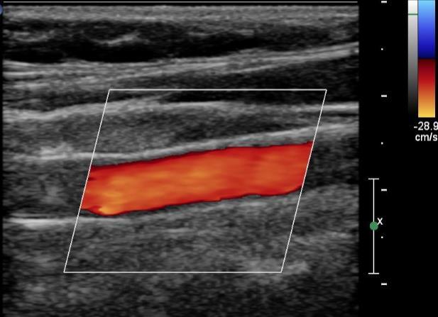 Duplex onderzoek Duplex = echografie + colour doppler Stroomsnelheid meten vóór en na stenose