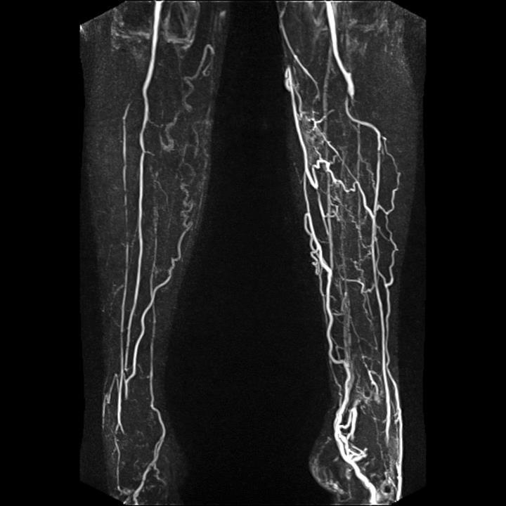 MRA MR angiografie: magnetisch veld & iv contrast Voordelen: non-invasief geen