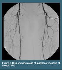 Digital Substraction Angiography Angiografie: