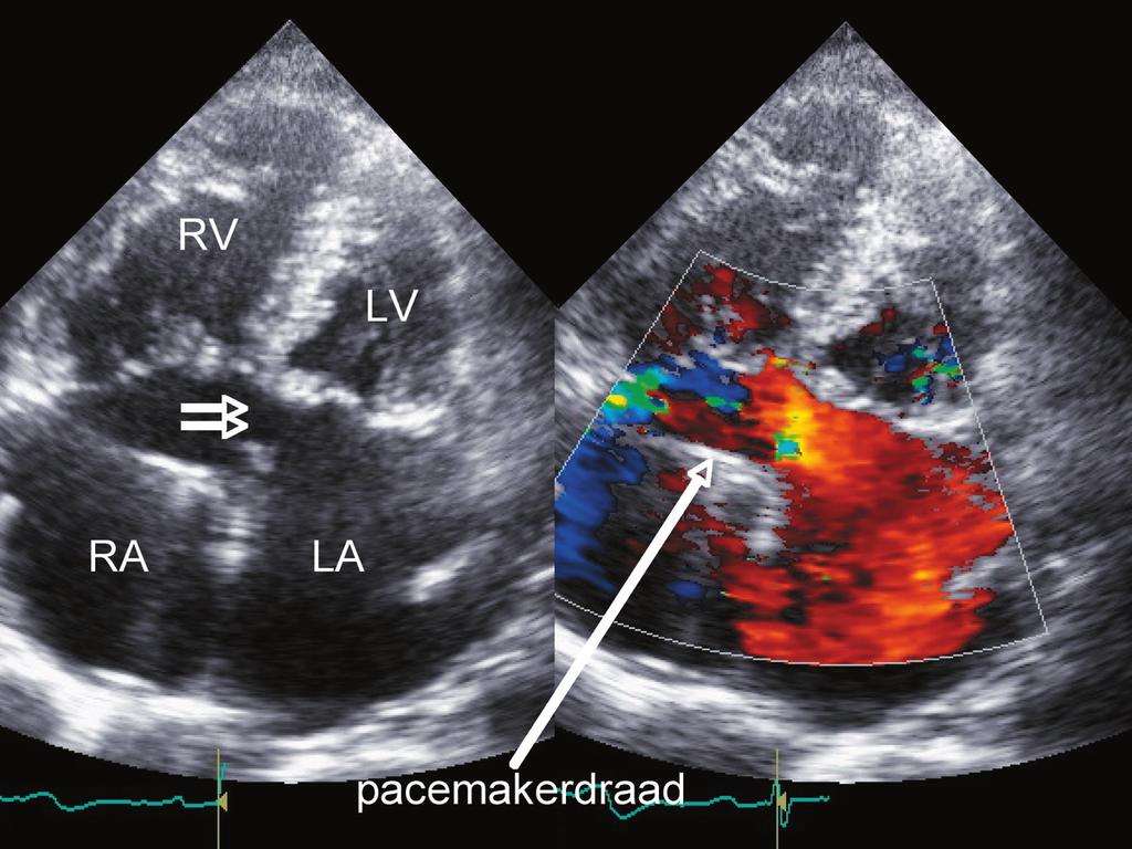 67.5 Zwangerschap. Figuur.3 Echocardiografische apicale vierkameropname van een incompleet AVSD (ASD I ) (dubbele pijl). Rechts: de shunt van LA naar RA is duidelijk zichtbaar.