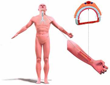 Tijdslijn tracheatransplantatie Sinds 2008 werden 6 patiënten behandeld met 8 tracheale allogreffes. 2 transplanten (casus 2 en 4) gingen verloren na stoppen van de immunosuppressietherapie.