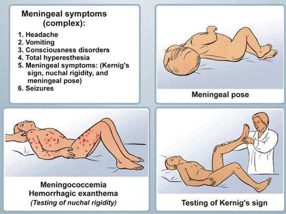 Headache (83%) Nausea (62%) Photofobia Rash(8%) Classic triad (fever, neck stiffness, altered mental state or