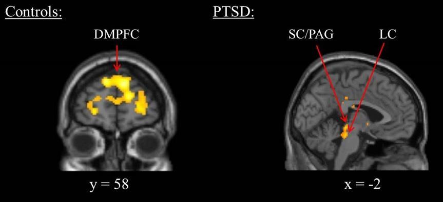 Steuwe et al (2014) Effect of direct eye contact in controls and PTSD DMPFC: