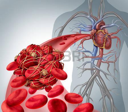 Een aneurysma kan in elke slagader in het lichaam ontstaan en dit kan leiden tot een breuk in een slagader wat kan resulteren in een levensbedreigende inwendige bloeding (figuur 51).