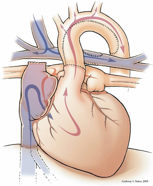 palliation The comprehensive stage 2