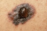 Gemetastaseerd melanoom In 2015: 5e meest voorkomende vorm van kanker Incidentie cutaan melanoom