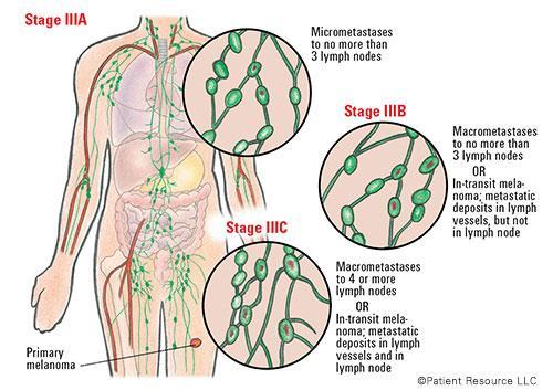 Adjuvant treatment of stage III(/IV) melanoma Stage III: patients with regional positive lymph nodes Stage 5-y melanoma specific surivival 5-y recurrence IIIA 78% 37% IIIB 59% 68%