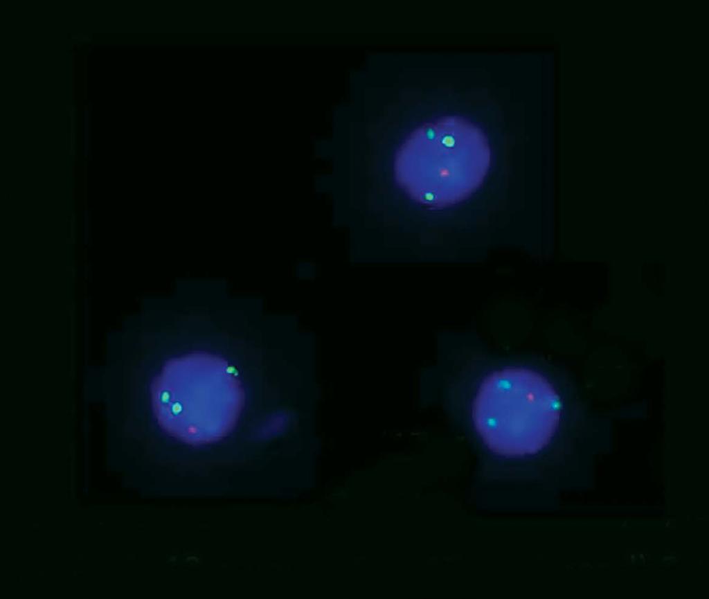 FISH op gezuiverde plasmacellen Groen: