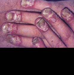 Psoriasis unguium Vaak zijn ook de nagels/vingertoppen aangedaan. Kenmerkend zijn kleine putjes in de nagel.