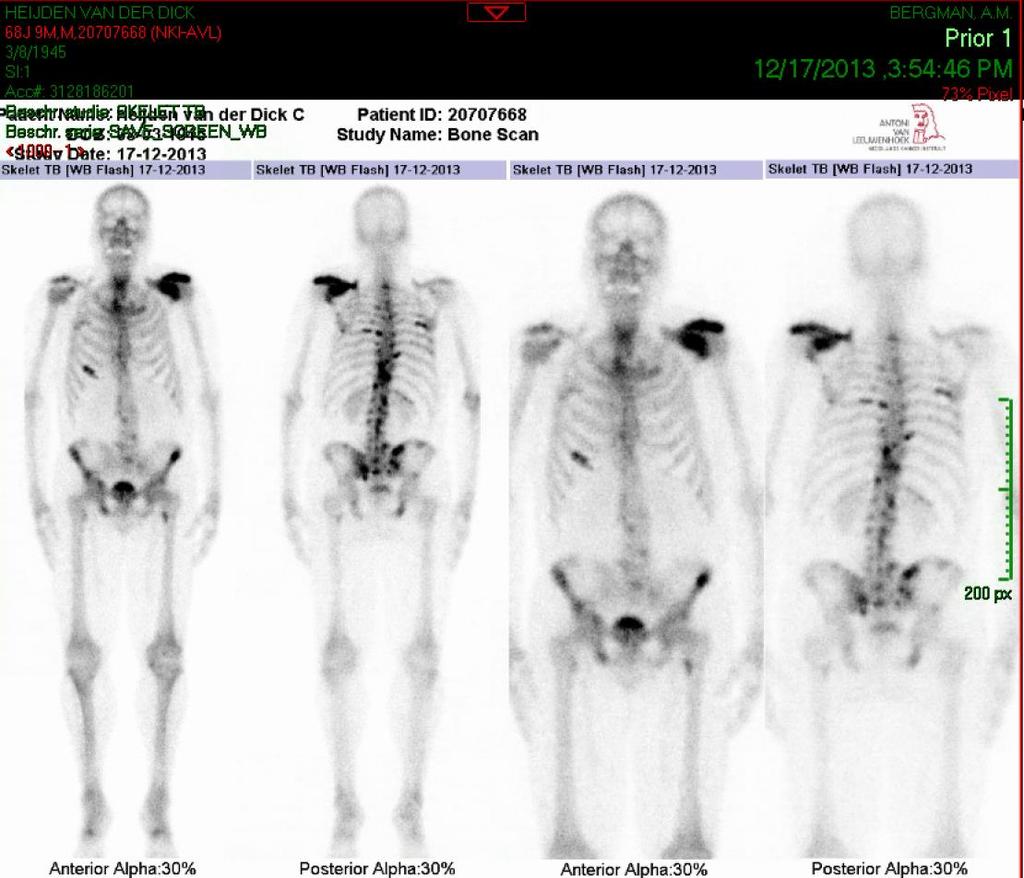 Casus 1: Patient behandeld met abiraterone Treatments should not be stopped for PSA progression alone Prior to abiraterone/p December 2013 CV 72 CV year old