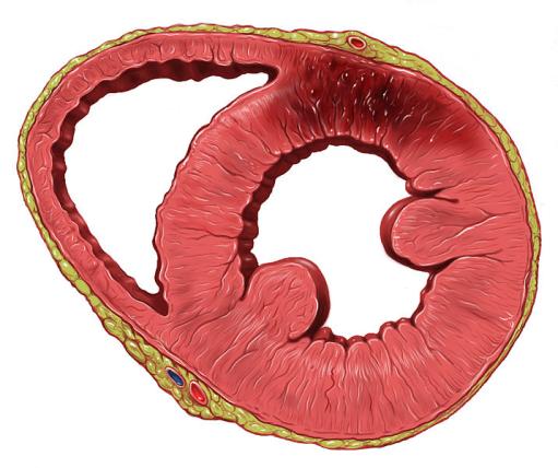 LV infarc0on LV infarc0on affects RV Prognos2c importance of right ventricular dysfunc2on acute inferior myocardial infarc0on LVEDP increase Interventricular septum RV aterload RV impairment recovers