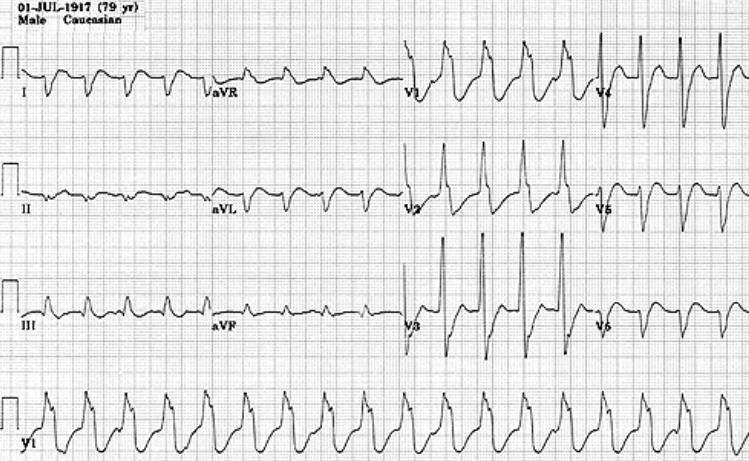 ECG 3 ECG 4