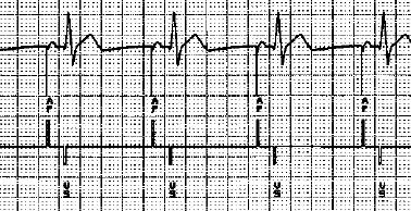 ECG 46