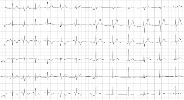 ECG 91 45