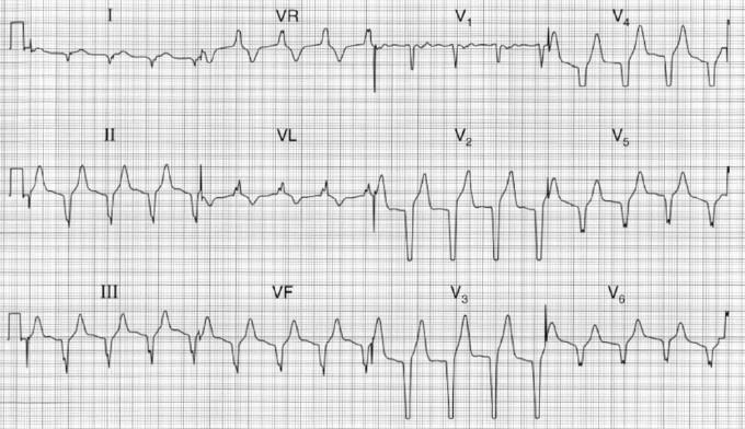 ECG 100: M, 45 j, 2u na