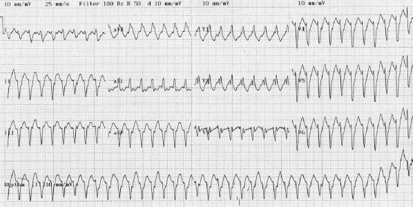 ECG 142