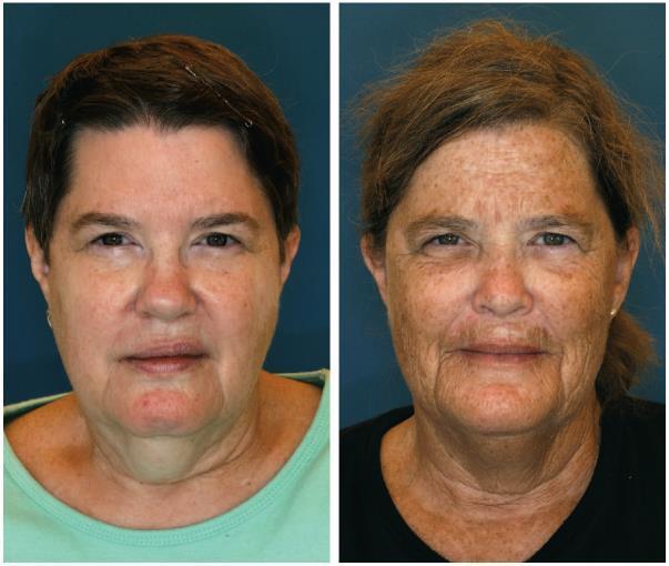 Guyuron et al. Factors contributing to the facial aging of identical twins.