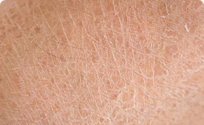 Epidermis