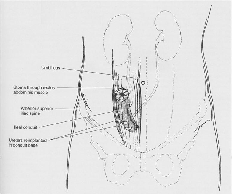 Urostoma volgens Bricker Procedure Stuk ileum, uretero-ileale anastomose Incontinent