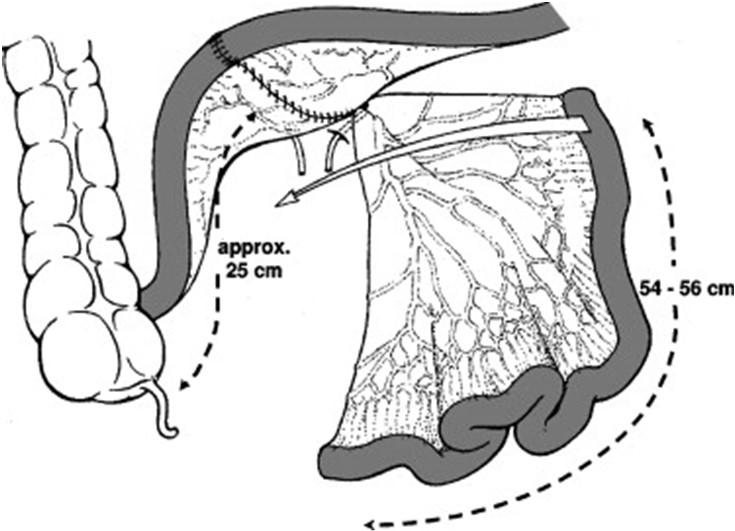 Orthotope neoblaas: Studer neoblaas