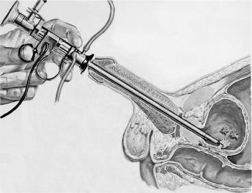 Trans-urethrale