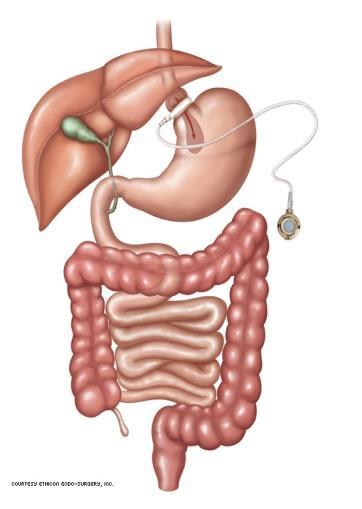 De meest gangbare ingrepen zijn momenteel een gastric bypass operatie en een gastric sleeve operatie. Het plaatsen van een maagband wordt steeds minder gedaan.