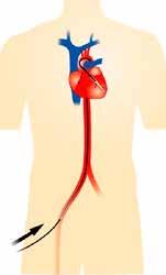 HARTKATHETERISATIE / 5 03 VERLOOP Bij een hartkatheterisatie wordt een dunne slang of katheter tot in het hart of