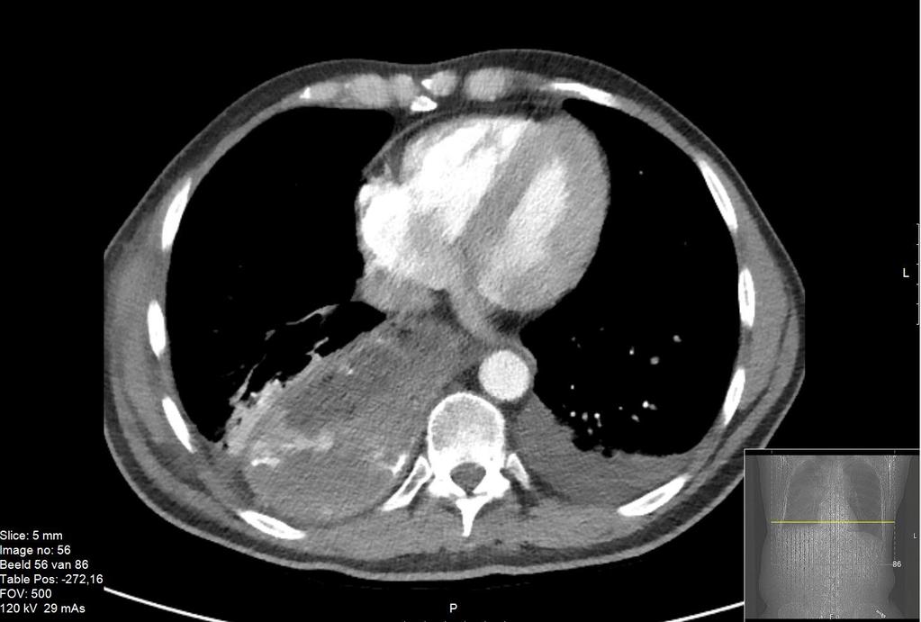 Dhr. B CT-scan dag 8 uitgezette