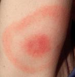 Tekenbeet Adviseer tot 3 maanden de plek controleren op groeiende rode kring Ziekte van Lyme 20% van de