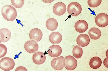 Diagnostiek trombocytose Primaire diagnostiek (reactief) Voorgeschiedenis (operatie, splenectomie, trombose, hematologische maligniteit,