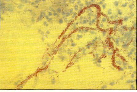 Ulcus molle, chancroid etiologie en pathogenese: Synoniemen: (weke sjanker/chancroïd) haemophilus ducreyi (Gram-negatief staafje) beschadigd epitheel is een voorwaarde voor het