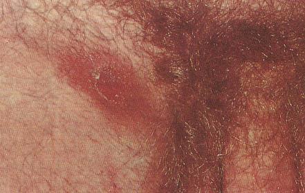 pijnlijk) bij mannen slechts 1 ulcus bij vrouwen multipele ulcera
