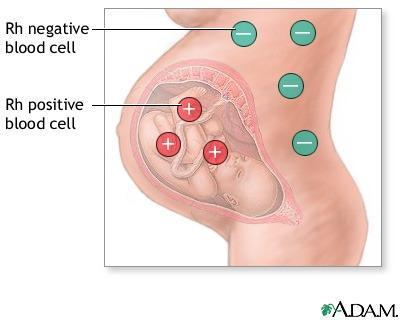 Anti-D immunoglobuline Rh(D) negatieve vrouwen met Rh(D) positieve kinderen