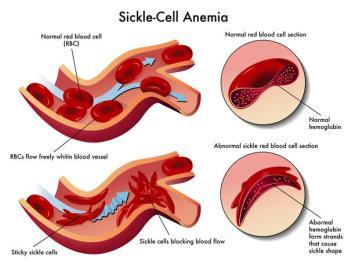 anemie Sikkel cel anemie Acute painfull episodes of sikkel cel crisis Pijn in thorax, abdomen, ledematen, rug Frequentie variabel,