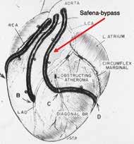 Deze behandeling heet een ballondilatatie van de kransslagader of met een moeilijk woord een percutane transluminale coronaire angioplastie of PTCA.
