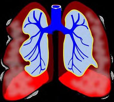HOE OMGAAN MET COPD? AANDACHT VOOR COPD COPD of chronisch obstructief longlijden is vaak nog onbekend. Toch komt de ziekte meer voor dan men denkt.