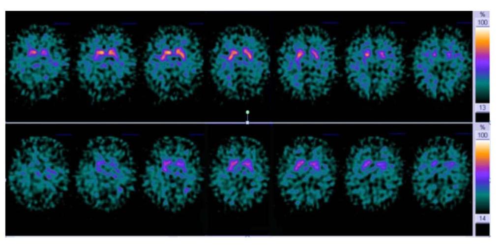 Biomarkers DAT-SPECT Binding tracer aan dopamine-cellen in de basale kernen