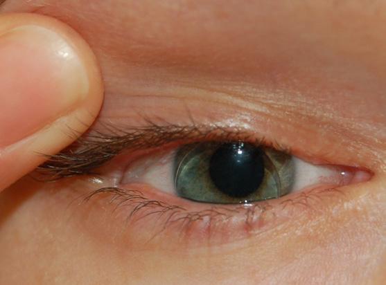 De lens wordt vooral aangepast bij personen waarbij een goed zicht niet kan bereikt worden met zachte contactlenzen en die niet goed kunnen wennen aan een harde contactlens.