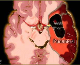 Hoofdstuk 2 Pathologie (Patho)fysiologie cerebrale bloeddoorstroming De hersenen behoren tot de best doorbloedde organen.
