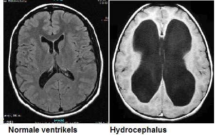 Liquorcirculatiestoornissen Stoornissen in de liquorcirculatie kunnen leiden tot een hydrocephalus. Er wordt gesproken van een hydrocephalus als het ventrikelsysteem een abnormaal grote inhoud heeft.