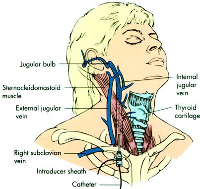 De bulbus jugularis is van groot belang voor de veneuze afvoer van bloed uit de hersenen. Flushen of blokkeren van de afvloed moet worden voorkomen, het kan leiden tot ernstige stijging van de ICP.
