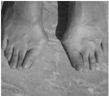 Neuropathie Perifere neuropathie Motorisch: Uitval voetspiertjes stand afwijkingen tenen Gevolg: Abnormale belasting van de voet Symptomen: Klauwtenen Hamertenen Hallux Valgus Holvoet Verandering van