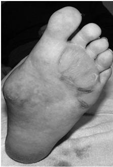 het voetgewelf Neuropathie Samengevat is de neuropathische voet: Warm en droog met zones van hyperkeratose of kloven en gedilateerde venen (autonome neuropathie) Hoog risico voor toegangspoort voor